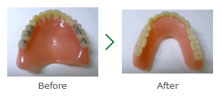 バリオデンチャーのビフォーアフター