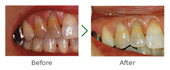ホワイトニングのビフォーアフター